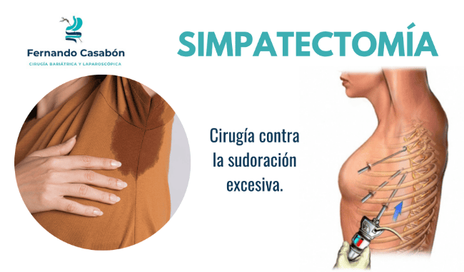 Simpatectomía