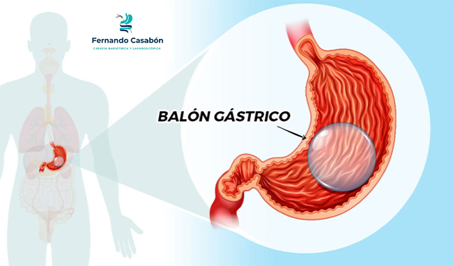 Balón Gástrico