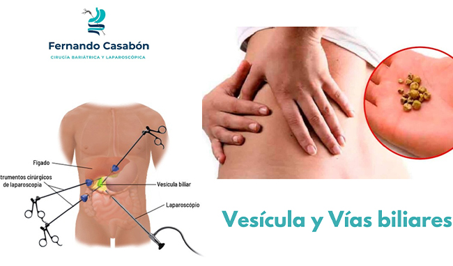 Vesícula y Vías Biliares