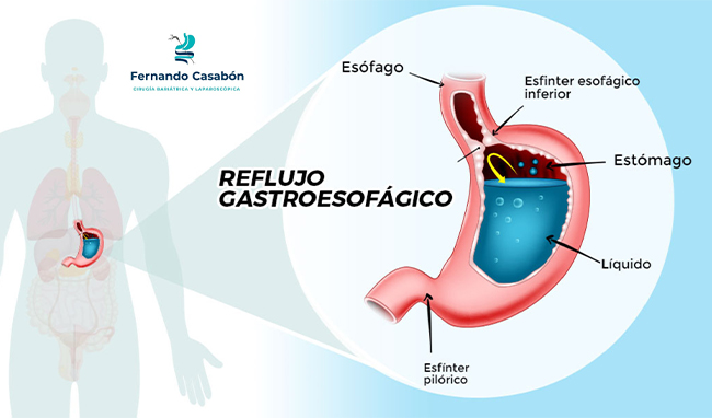 Cirugía Antirreflujo