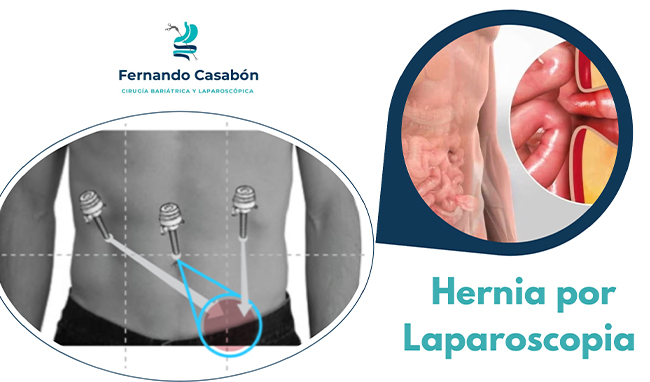 Hernia por Laparoscopía
